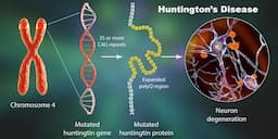 Gene Therapy Slows Huntington's Disease Progression by 75% in Landmark Trial