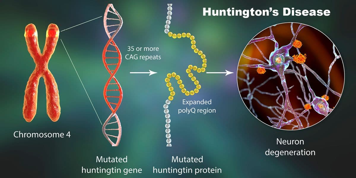 Image for Gene Therapy Slows Huntington's Disease Progression by 75% in Landmark Trial