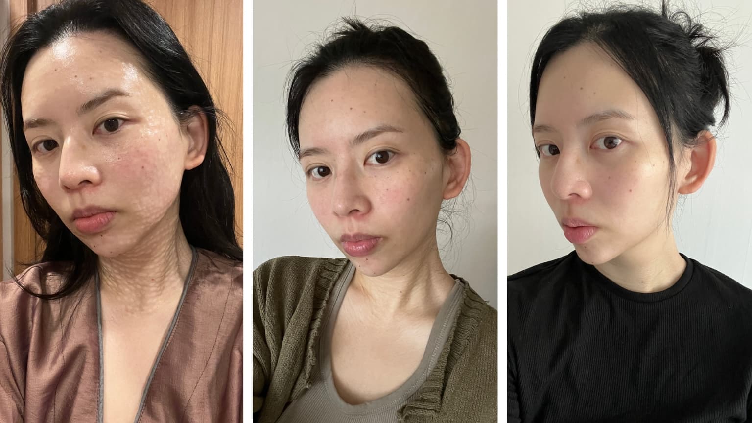 Image for Rejuran Injections Attract U.S. Travelers to South Korea Amid Pending FDA Approval and Doctor Skepticism
