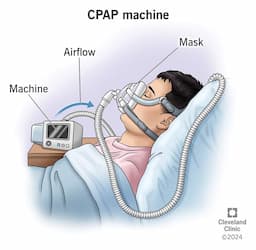 Untreated Sleep Apnea Increases Sudden Death Risk by 30%, Experts Warn