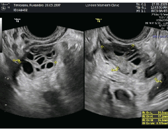 Image for Genomic Scientist Highlights Misdiagnosis of Ovarian Structures, Revealing 50 Antral Follicles