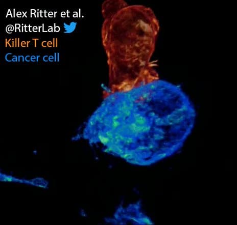 Image for Advanced Imaging Reveals Ovarian Cancer's ESCRT-Mediated Defense Against T-Cell Assault