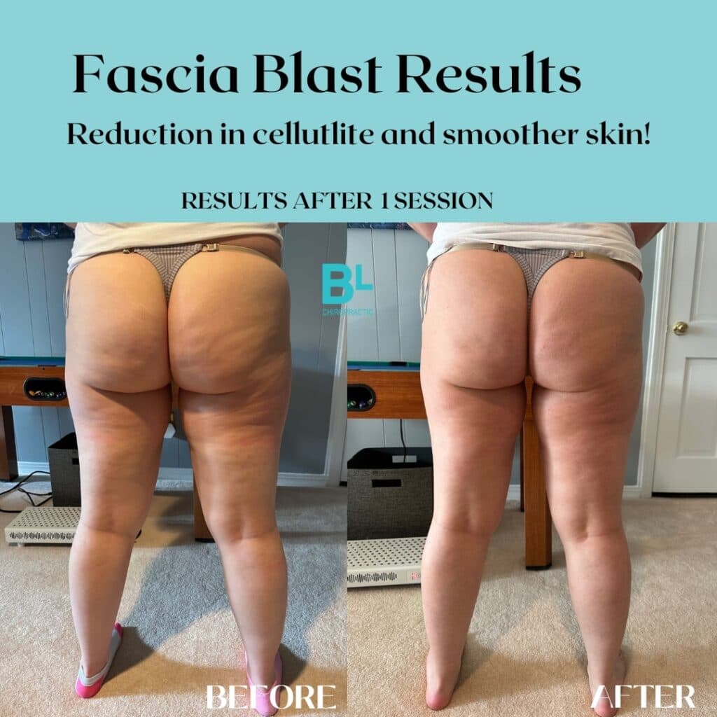 Image for 80-90% of Women Affected: Research Confirms Fascia's Primary Role in Cellulite Formation, Shifting Focus from Fat