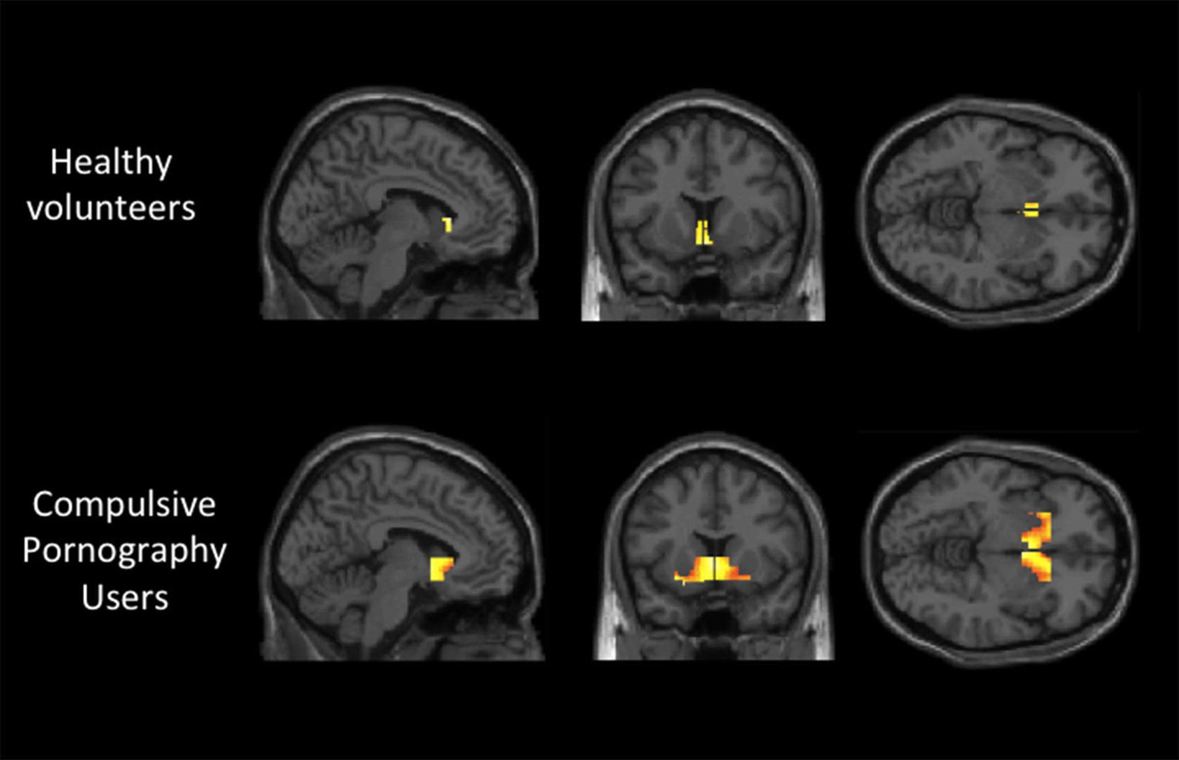 Image for Research Explores Problematic Pornography Use's Impact on Male Brain, Citing Addiction-Like Patterns